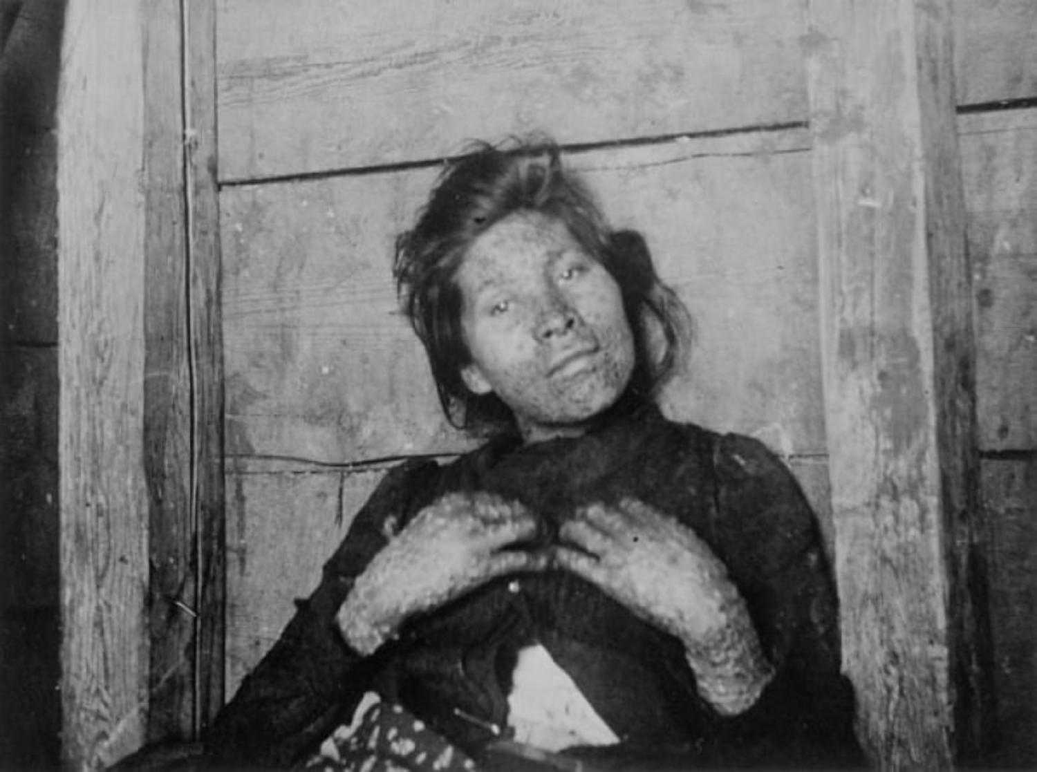 A small pox victim in the 1860s. The scars often remained for life, for those who lived.